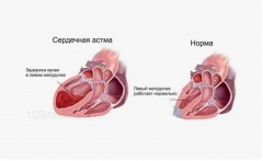 Сердечная астма - причины, симптомы, лечение и профилактика